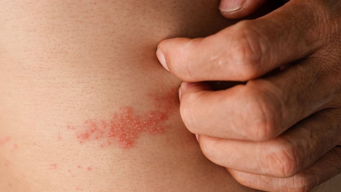 Illness symptoms of shingles on the skin, rash and blisters.